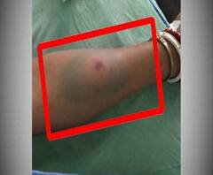 রহস্যজনক পোকার কামড়ে গৃহবধূর মৃত্যু, ধোঁয়াশায় চিকিৎসকরা