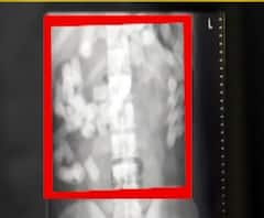 Drug Smuggling | अफगाण टोळीची करामत, पोटातून 10 कोटींचं ड्रग्ज तस्करी करणारे गजाआड | स्पेशल रिपोर्ट | ABP Majha