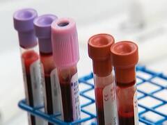 COVID-19: Four cases reported in Noida so far