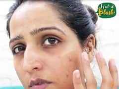 How to treat minor acne and scars with aloe Vera gel| Wat d Blush