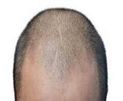 উদ্বেগের কারণ এবার মাথার টাক! করোনা সংক্রমণে বাড়তে পারে ঝুঁকি 