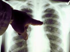 2025 तक देश में महामारी बन जाएगा Cancer, 12% तक बढ़ जाएंगे मामले: ICMR की डराने वाली रिपोर्ट 