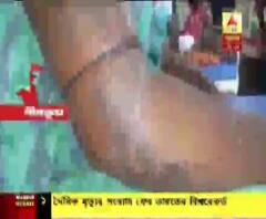 স্বামীর দ্বিতীয় বিয়ের প্রতিবাদ, বীরভূমে স্ত্রী উপর অ্যাসিড হামলা 