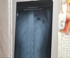 ऑपरेशन के बाद पेट में छोड़ दिया ब्लेड, युवक ने किया अस्पताल पर केस | Purab Pashchim 