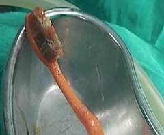 Special Report | घाईगडबडीत टूथब्रश पोटात, ब्रश काढण्यासाठी पोटावर शस्त्रक्रिया 