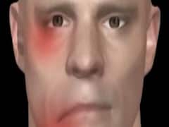 Side effects of Pfizer's Corona vaccine include Bell's Palsy; know all about it